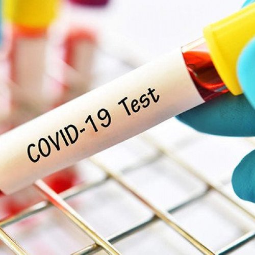 Bakıda koronavirus testi neqativ çıxdı, pozitiv təqdim etdilər