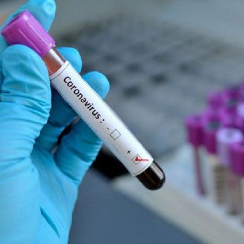 Azərbaycanda 77 nəfərdə koronavirus aşkarlandı - 15 nəfər sağaldı