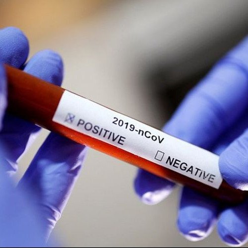 Azərbaycanda aparılan koronavirus testlərinin sayı 100 mini keçib